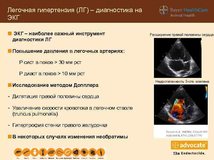 Легочная гипертензия (ЛГ) – диагностика на ЭКГ – наиболее важный инструмент диагностики ЛГ Расширение