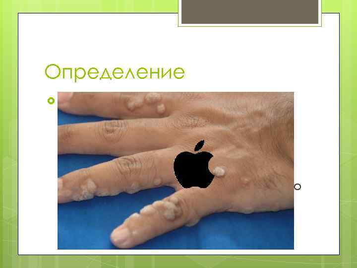 Определение Вирус папилломы человека (ВПЧ) является самой распространенной вирусной инфекцией половых путей. Большинство сексуально