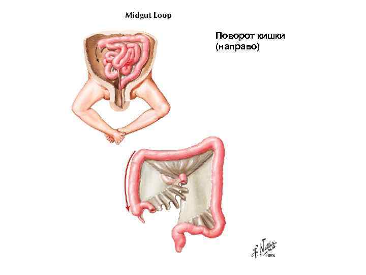 Поворот кишки (направо) 