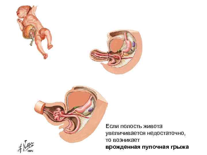 Если полость живота увеличивается недостаточно, то возникает врожденная пупочная грыжа 