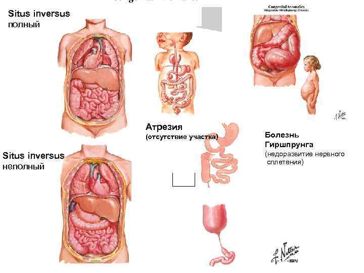 Situs inversus полный Атрезия (отсутствие участка) Situs inversus неполный Болезнь Гиршпрунга (недоразвитие нервного сплетения)