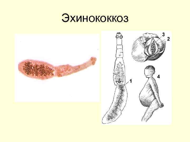 Эхинококкоз 
