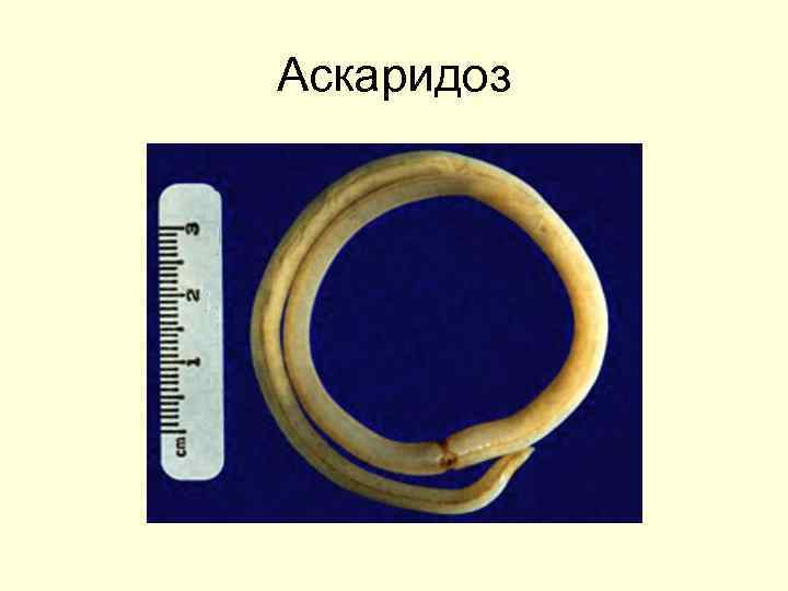 Аскаридоз 