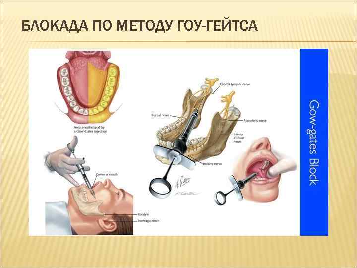 БЛОКАДА ПО МЕТОДУ ГОУ-ГЕЙТСА 