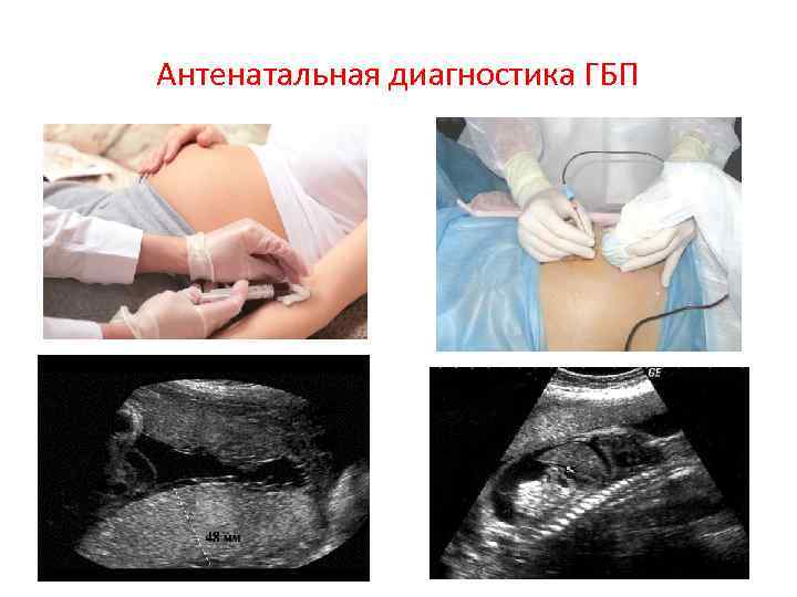 Антенатальная диагностика ГБП 