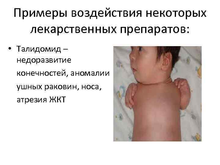 Примеры воздействия некоторых лекарственных препаратов: • Талидомид – недоразвитие конечностей, аномалии ушных раковин, носа,