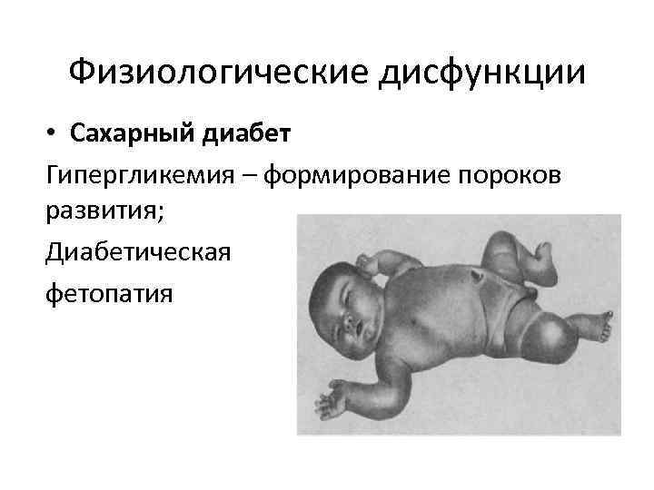 Физиологические дисфункции • Сахарный диабет Гипергликемия – формирование пороков развития; Диабетическая фетопатия 