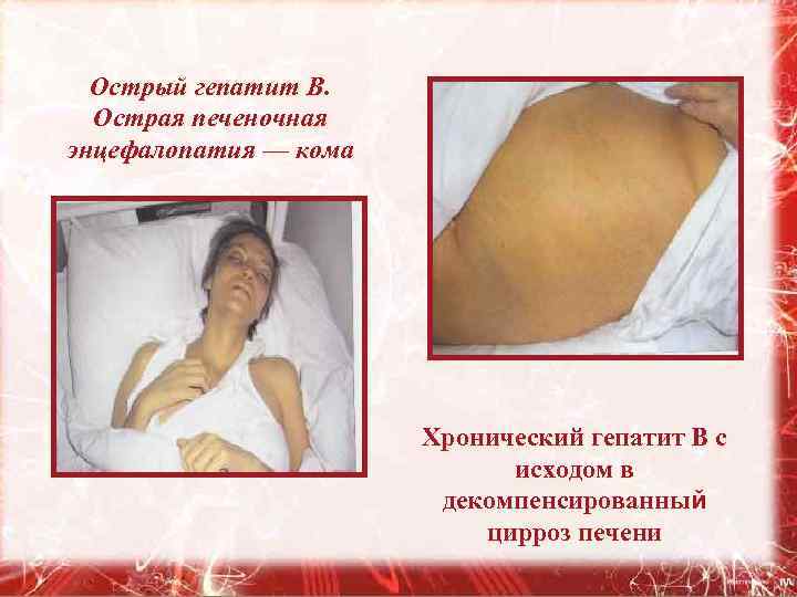 Острый гепатит В. Острая печеночная энцефалопатия — кома Хронический гепатит В с исходом в