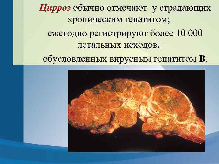 Цирроз обычно отмечают у страдающих хроническим гепатитом; ежегодно регистрируют более 10 000 летальных исходов,