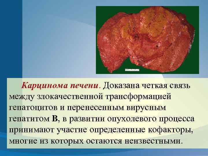 Карцинома печени. Доказана четкая связь между злокачественной трансформацией гепатоцитов и перенесенным вирусным гепатитом В,