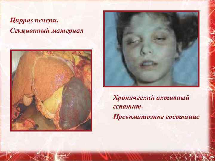 Цирроз печени. Секционный материал Хронический активный гепатит. Прекоматозное состояние 