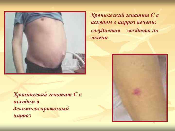 Хронический гепатит С с исходом в цирроз печени: сосудистая звездочка на голени Хронический гепатит