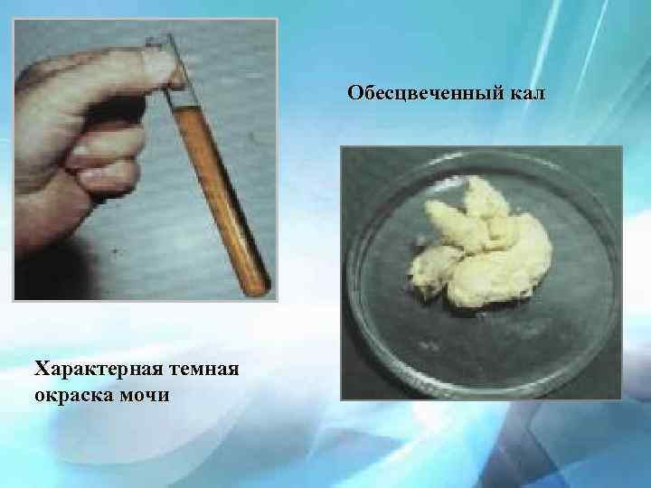 Обесцвеченный кал Характерная темная окраска мочи 