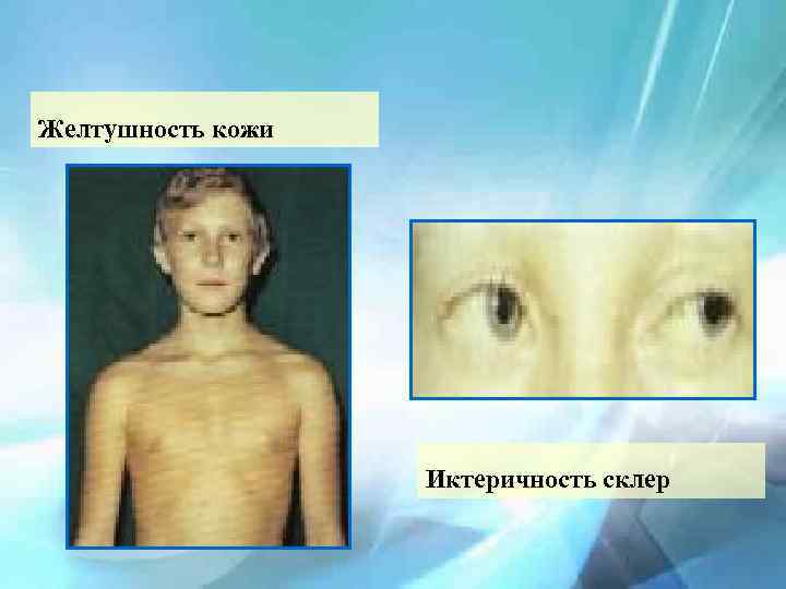 Желтушность кожи Иктеричность склер 