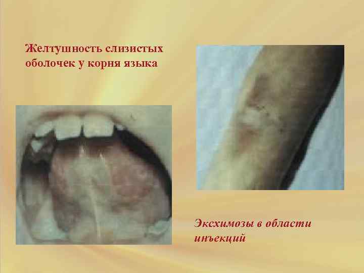 Желтушность слизистых оболочек у корня языка Эксхимозы в области инъекций 