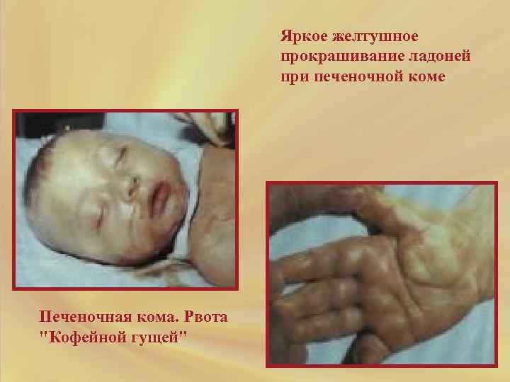 Яркое желтушное прокрашивание ладоней при печеночной коме Печеночная кома. Рвота "Кофейной гущей" 