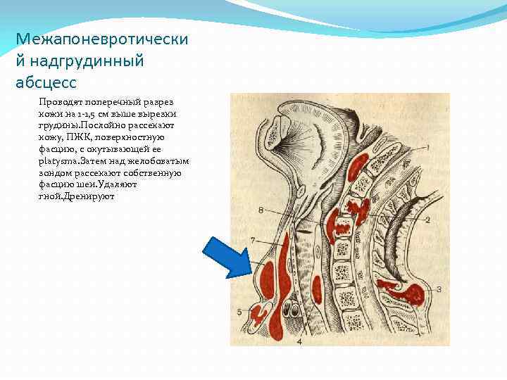 Как выглядит абсцесс при ангине фото