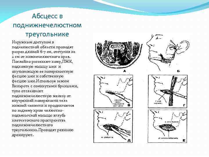 Желобоватый зонд фото