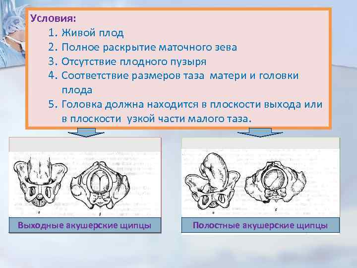 Головка плода в полости малого таза. Полное раскрытие маточного зева. Извлечение плода в головке таза. Конфигурация головки плода. Головка плода в узкой части полости малого таза.