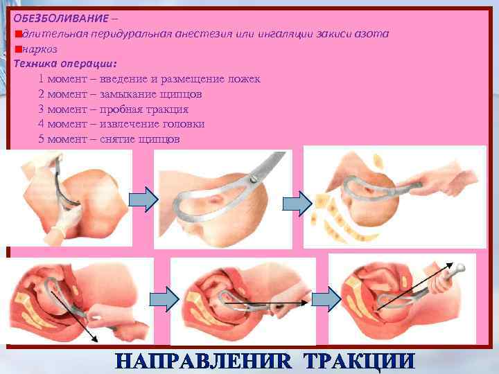 ОБЕЗБОЛИВАНИЕ – длительная перидуральная анестезия или ингаляции закиси азота наркоз Техника операции: 1 момент