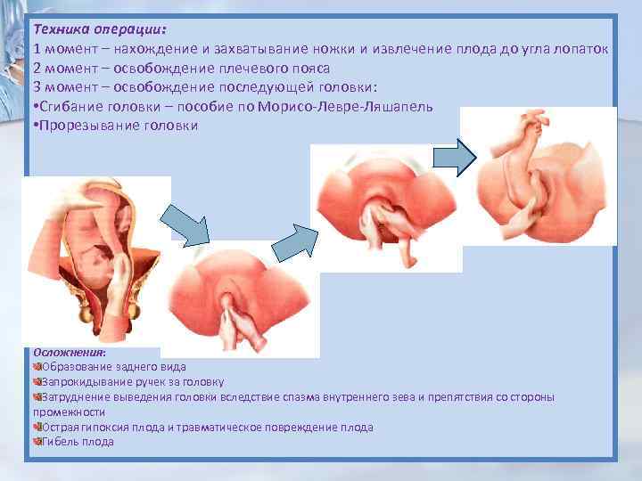 Техника операции: 1 момент – нахождение и захватывание ножки и извлечение плода до угла