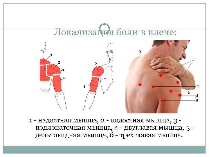 Локализация боли в плече: 1 - надостная мышца, 2 - подостная мышца, 3 -