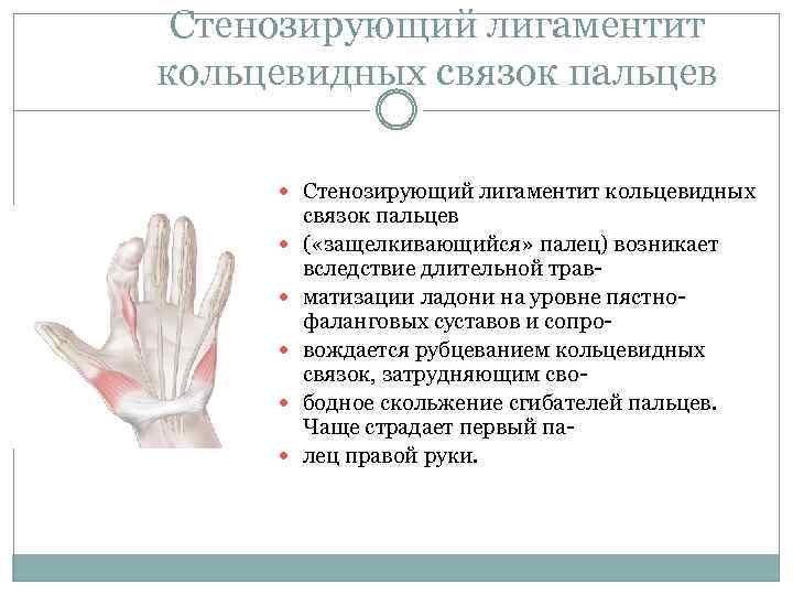Стенозирующий лигаментит кольцевидных связок пальцев Стенозирующий лигаментит кольцевидных связок пальцев ( «защелкивающийся» палец) возникает