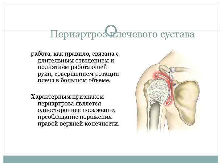 Периартроз плечевого сустава работа, как правило, связана с длительным отведением и поднятием работающей руки,
