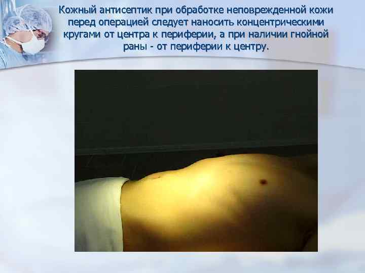 Кожный антисептик при обработке неповрежденной кожи перед операцией следует наносить концентрическими кругами от центра