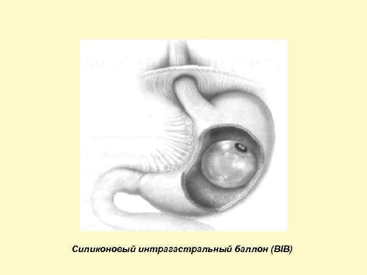 Силиконовый интрагастральный баллон (BIB) 