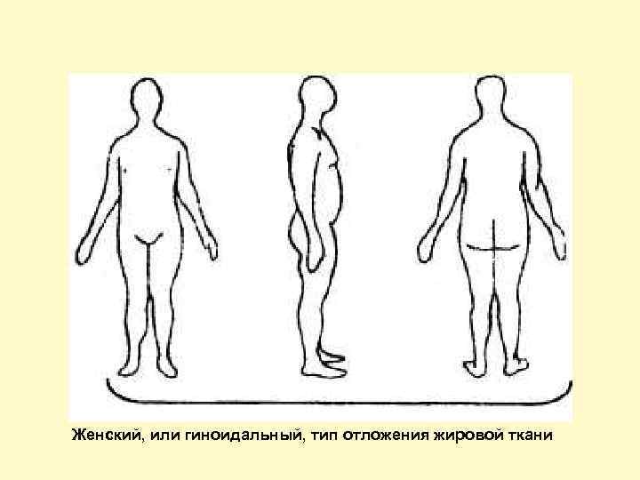 Женский, или гиноидальный, тип отложения жировой ткани 