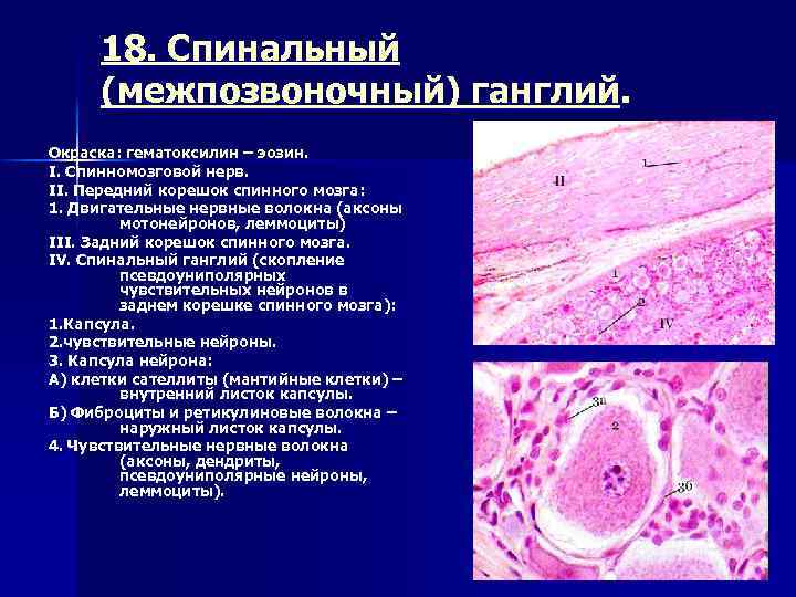 18. Спинальный (межпозвоночный) ганглий. Окраска: гематоксилин – эозин. I. Спинномозговой нерв. II. Передний корешок