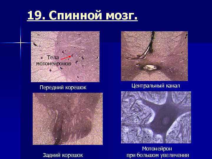 19. Спинной мозг. Тела мотонейронов Передний корешок Задний корешок Центральный канал Мотонейрон при большом