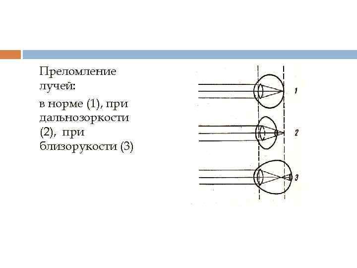 Преломление лучей: в норме (1), при дальнозоркости (2), при близорукости (3) 
