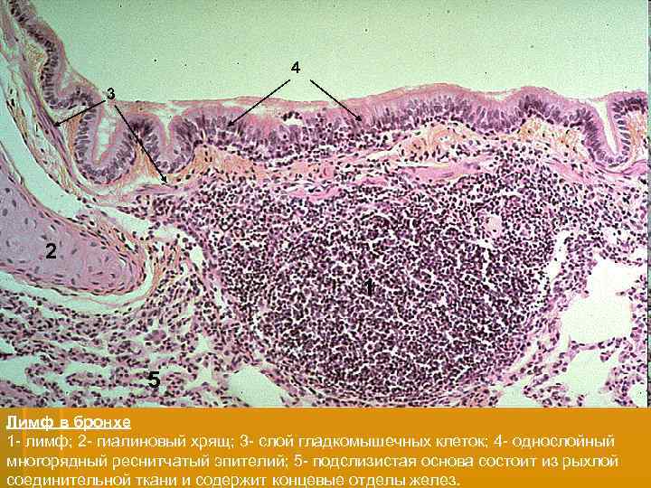 4 3 2 1 5 Лимф в бронхе 1 - лимф; 2 - гиалиновый