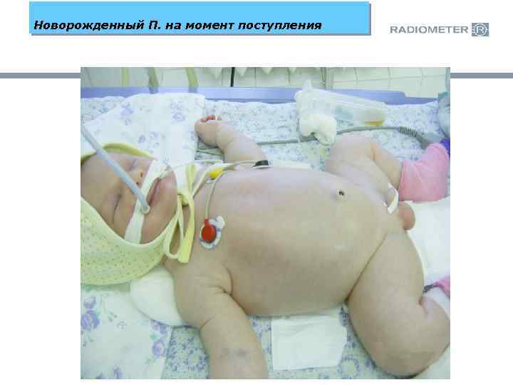 Новорожденный П. на момент поступления 