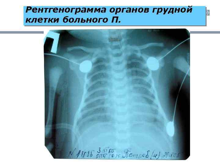 Рентгенограмма органов грудной клетки больного П. 