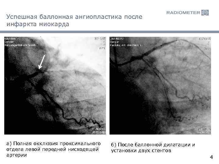 Успешная баллонная ангиопластика после инфаркта миокарда а) Полная окклюзия проксимального отдела левой передней нисходящей