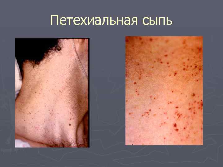 Петехиальная сыпь 