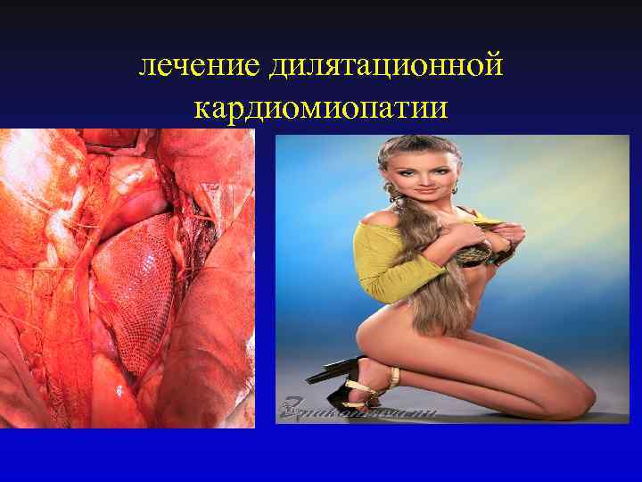 лечение дилятационной кардиомиопатии 