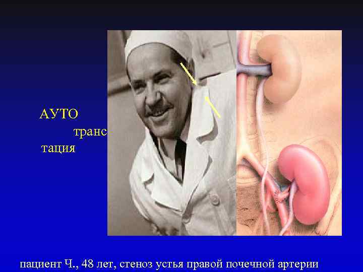 АУТО трансплан тация пациент Ч. , 48 лет, стеноз устья правой почечной артерии 