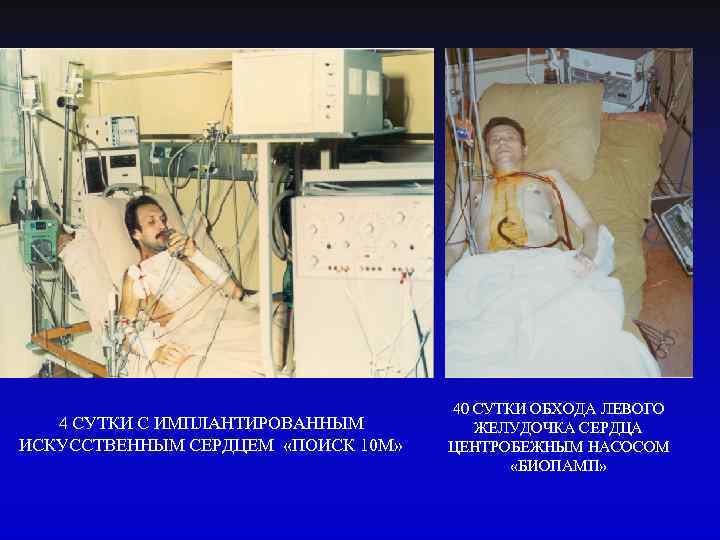 4 СУТКИ С ИМПЛАНТИРОВАННЫМ ИСКУССТВЕННЫМ СЕРДЦЕМ «ПОИСК 10 М» 40 СУТКИ ОБХОДА ЛЕВОГО ЖЕЛУДОЧКА