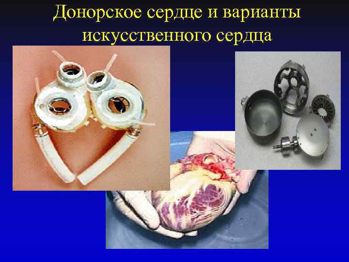 Донорское сердце и варианты искусственного сердца 