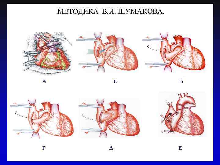 МЕТОДИКА В. И. ШУМАКОВА. 