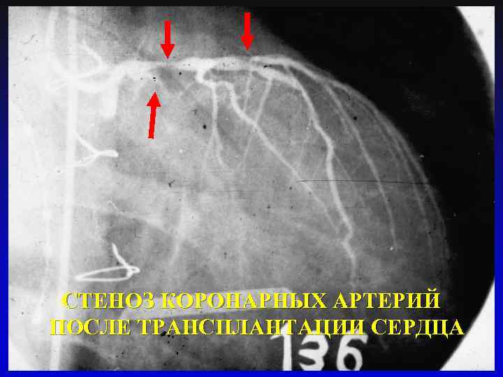 СТЕНОЗ КОРОНАРНЫХ АРТЕРИЙ ПОСЛЕ ТРАНСПЛАНТАЦИИ СЕРДЦА 