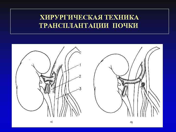 ХИРУРГИЧЕСКАЯ ТЕХНИКА ТРАНСПЛАНТАЦИИ ПОЧКИ 