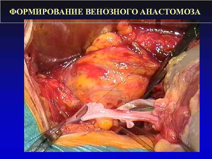ФОРМИРОВАНИЕ ВЕНОЗНОГО АНАСТОМОЗА 