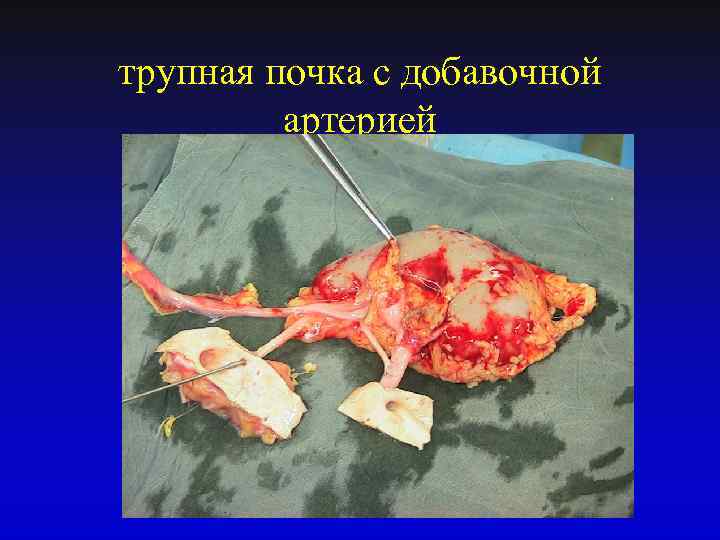 трупная почка с добавочной артерией 