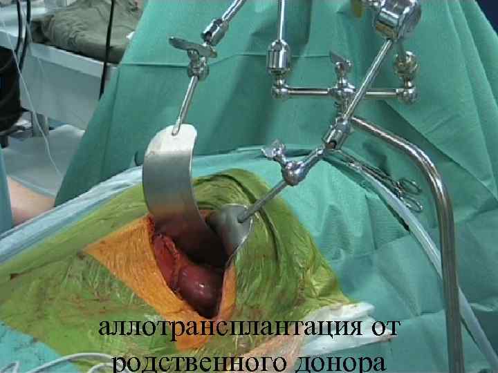 аллотрансплантация от родственного донора 