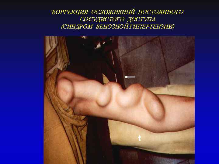 КОРРЕКЦИЯ ОСЛОЖНЕНИЙ ПОСТОЯННОГО СОСУДИСТОГО ДОСТУПА (СИНДРОМ ВЕНОЗНОЙ ГИПЕРТЕНЗИИ) 